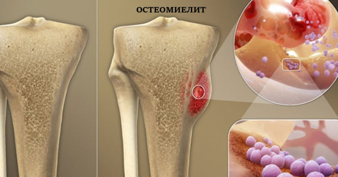 Остеомиелит